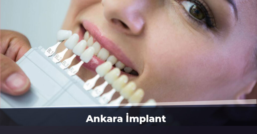 Ankara İmplant Ankara İmplant Ücretleri