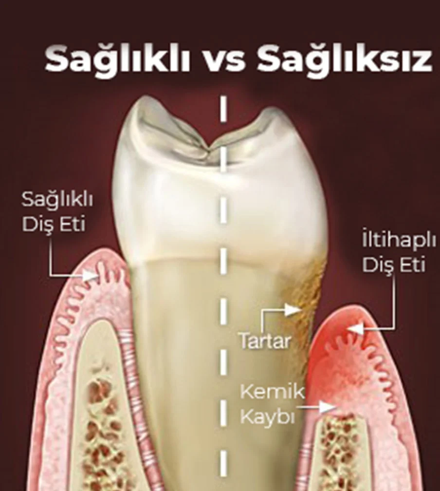 dis-eti-cekilmesine-ne-iyi-gelir