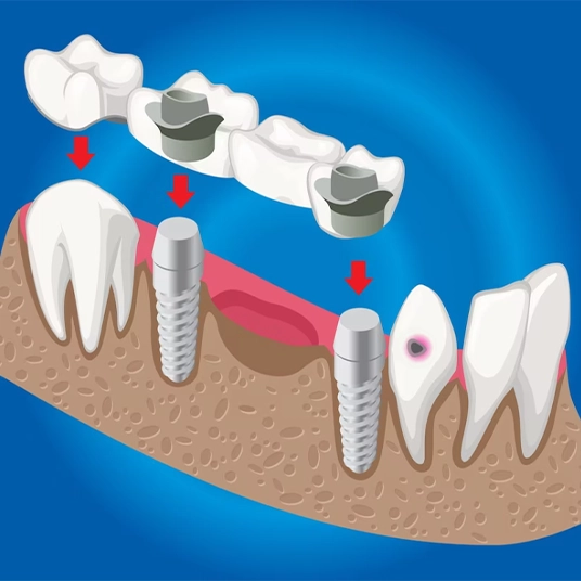 implants-procedure-steps