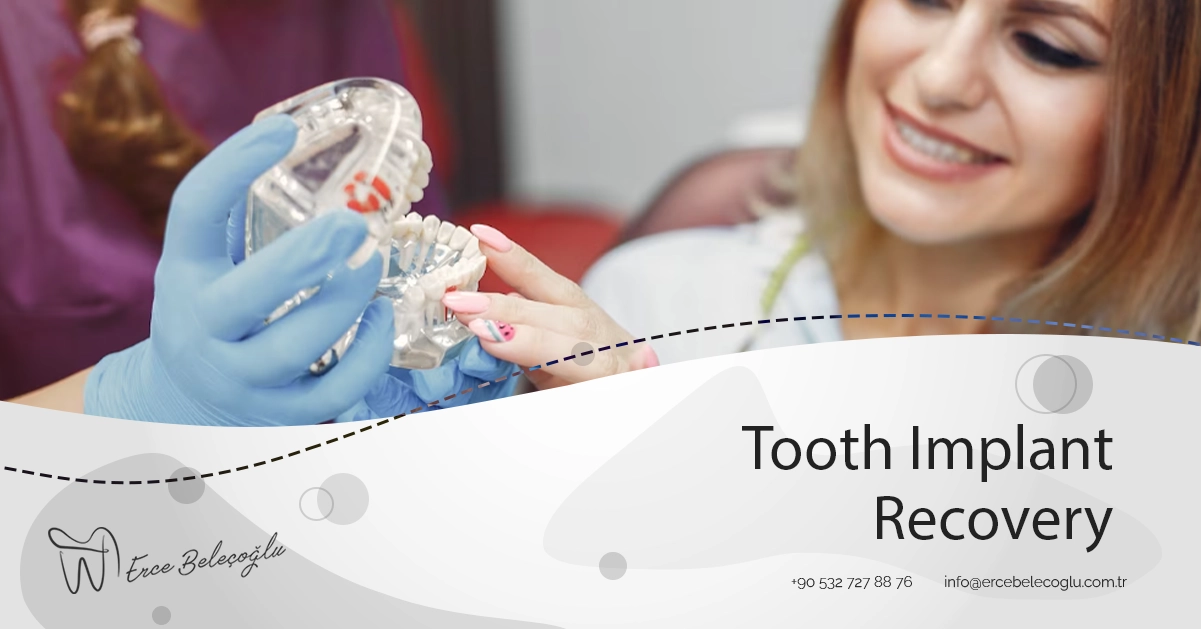 Tooth Implant Recovery Tooth Implant Recovery Time