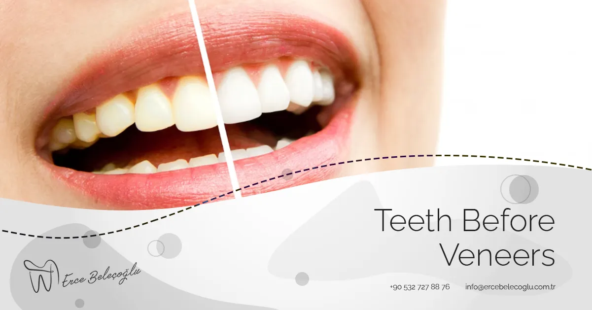 Teeth Before Veneers