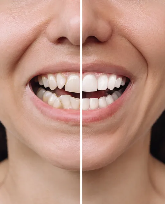 Before and After Veneers