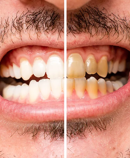 Before and After Veneers