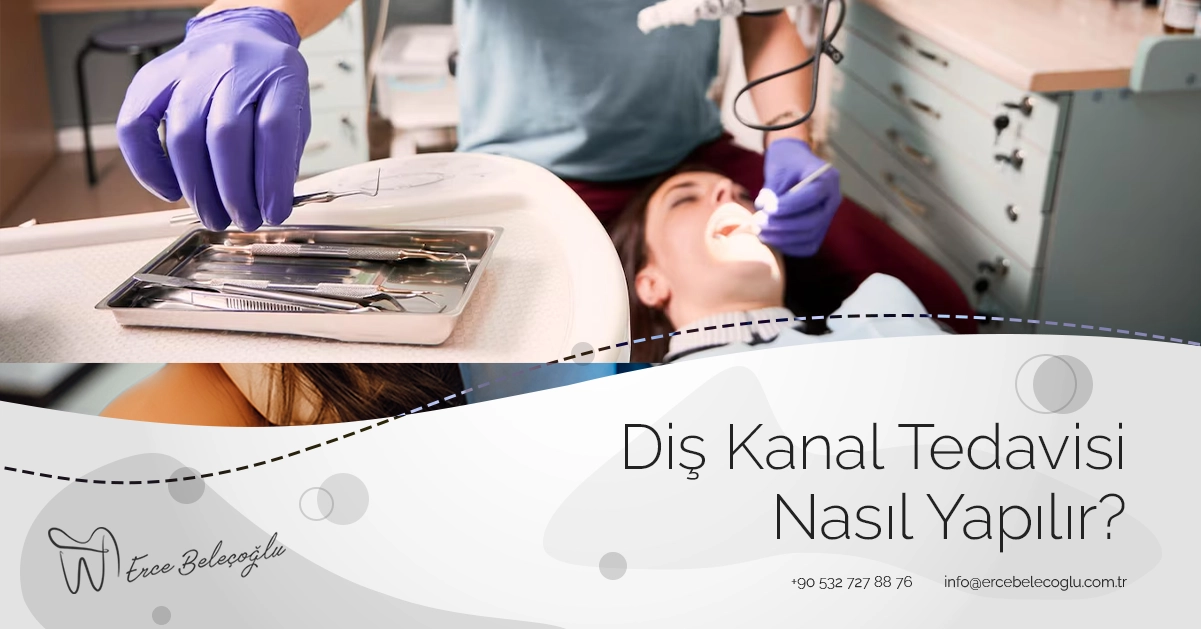 Diş Kanal Tedavisi Nasıl Yapılır?