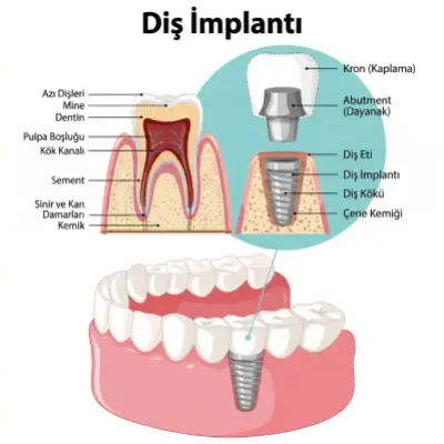 Diş İmplantı Tedavisi