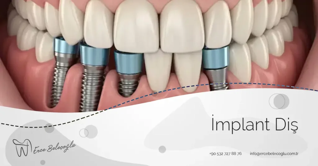 implant diş Fiyatları 2026