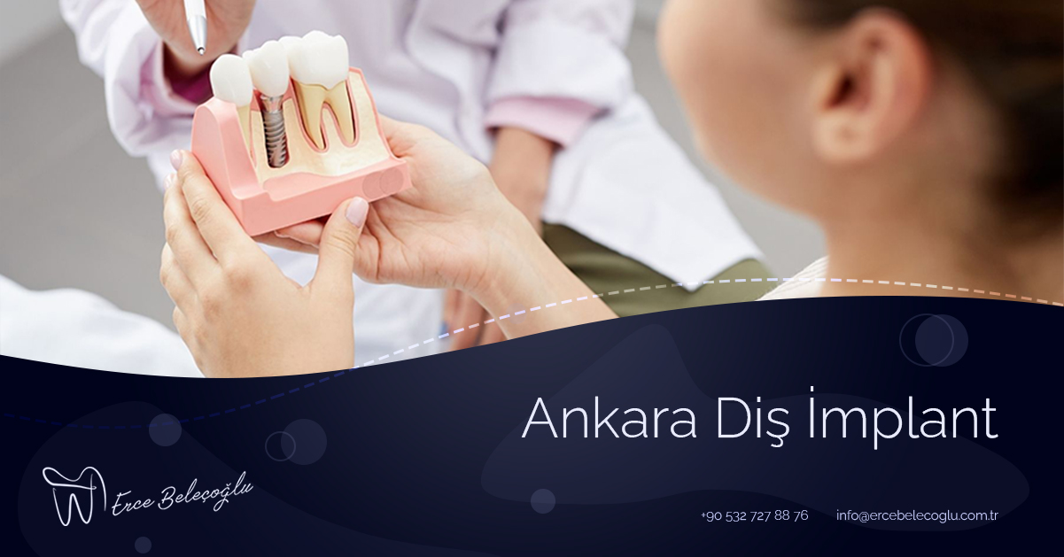 Ankara Diş İmplant