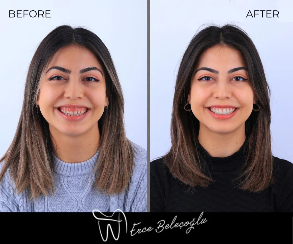 Gummy Smile Gülüş Tasarımı