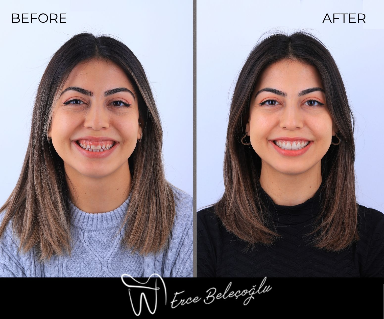 Gummy Smile Gülüş Tasarımı