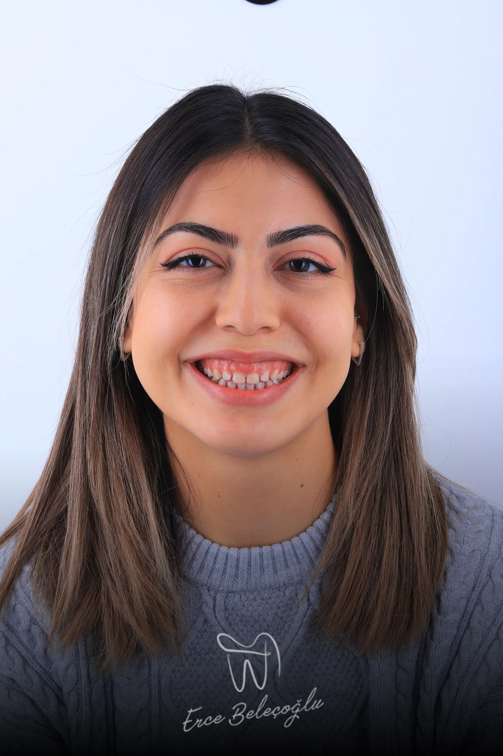 Gummy Smile Gülüş Tasarımı